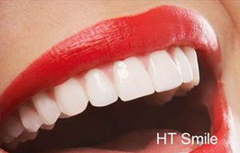 Răng sứ HT Smile